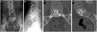 Development of a Computer-Aided Design and Finite Element Analysis Combined Method for Affordable Spine Surgical Navigation With 3D-Printed Customized Template